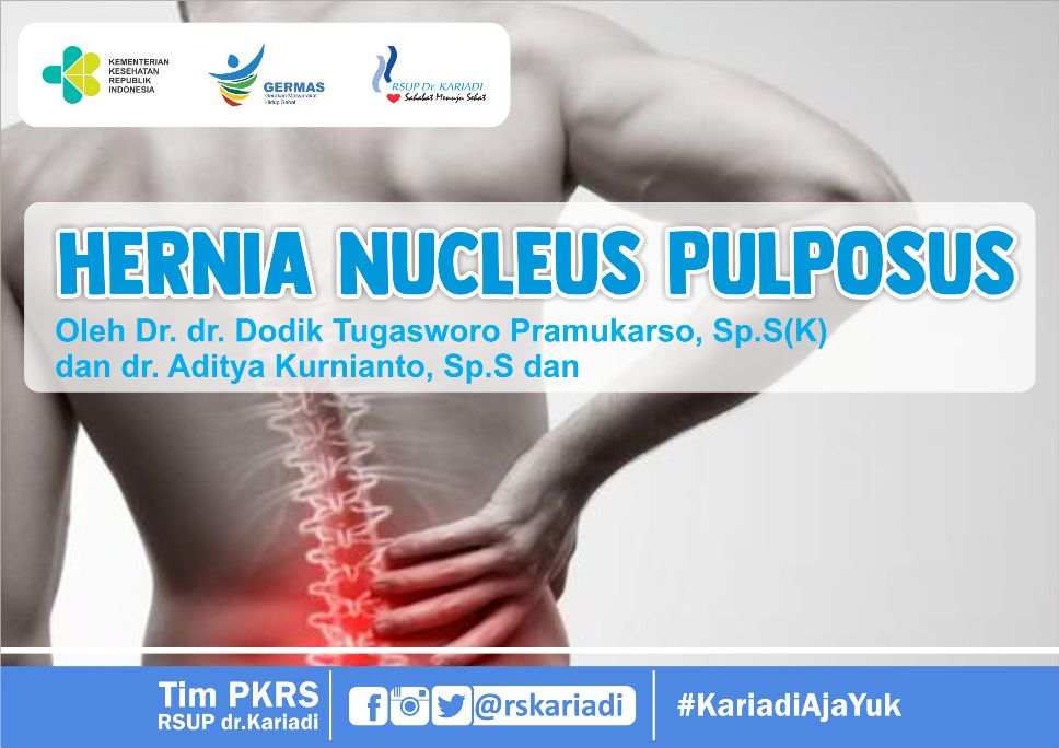 Mengatasi Hernia Nukleus Pulposus: Solusi untuk Sakit Tulang Belakang yang Menyiksa Mengatasi Hernia Nukleus Pulposus: Solusi untuk Sakit Tulang Belakang yang Menyiksa