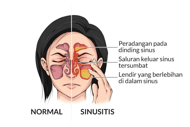 Mengatasi Sakit Kepala Sinus: Penyebab, Gejala, dan Pengobatan