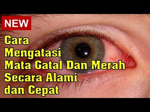 Memahami Sakit Mata pada Bayi: Gejala, Penyebab, dan Pencegahan Memahami Sakit Mata pada Bayi: Gejala, Penyebab, dan Pencegahan